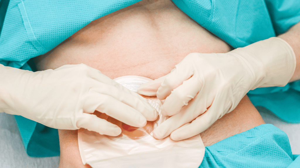 Putting on a stoma bag