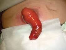 Picture of a stoma prolapse