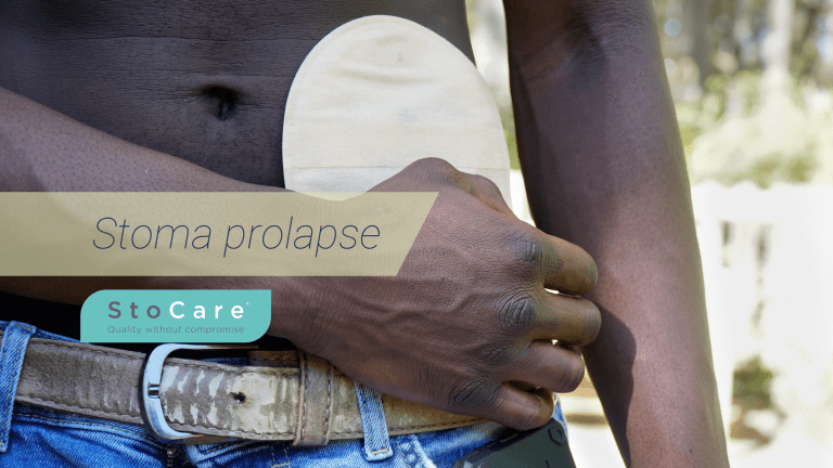 Stoma prolapse