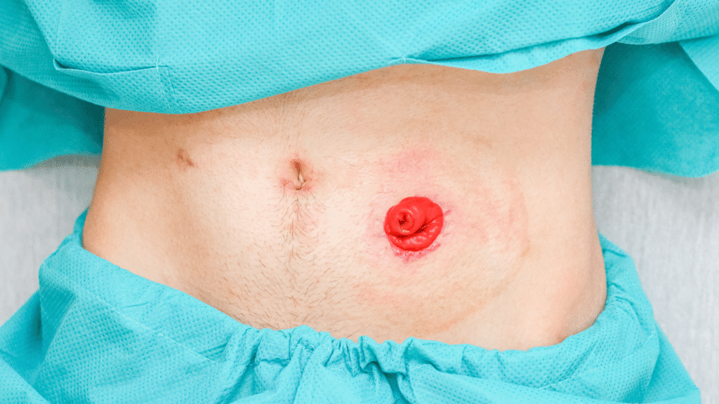 Stoma granuloma picture. Peristomal skin is irritated.