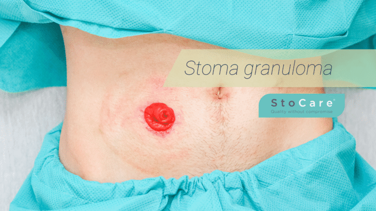 Stoma granuloma