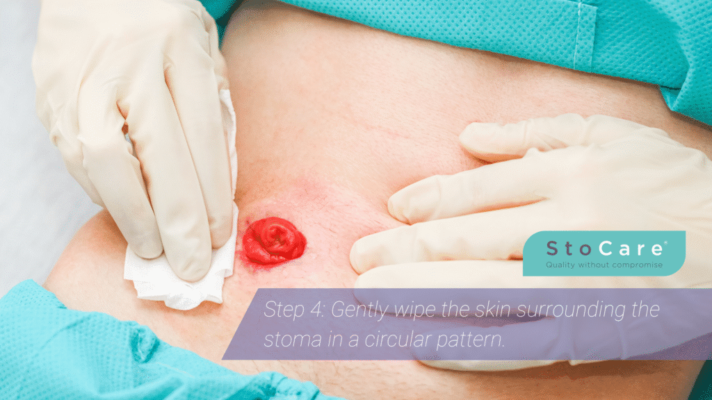 How to clean a stoma. Step 4: Gently wipe the skin surrounding the stoma in a circular pattern.