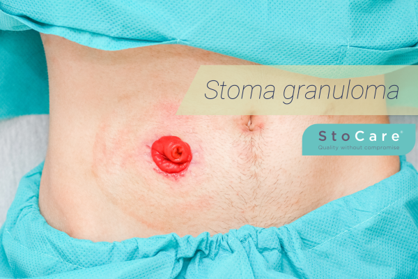 Stoma granuloma