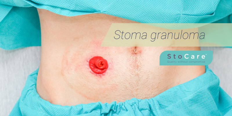 Stoma granuloma