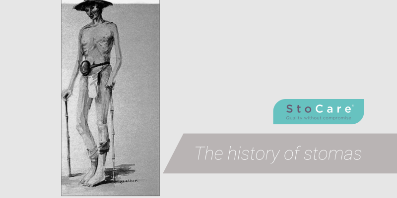 the history of stomas