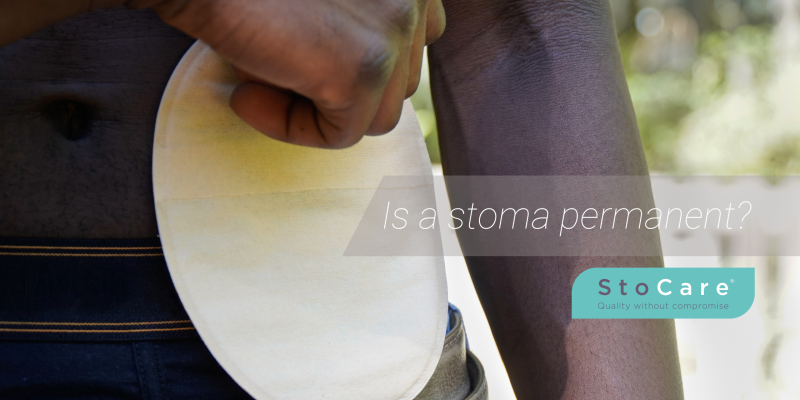 Is a stoma permanent? From StoCare.