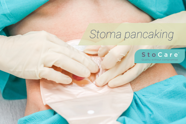 Stoma pancaking from StoCare.