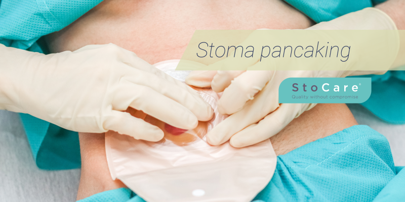 Stoma pancaking from StoCare.