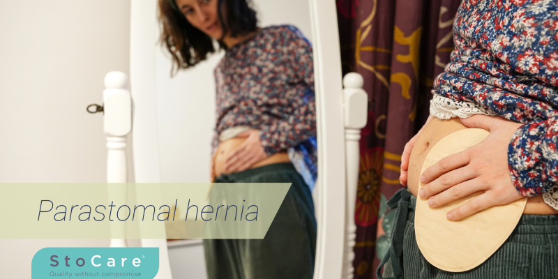 Parastomal hernia